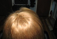 After Trichotillomania Treatment, Back View